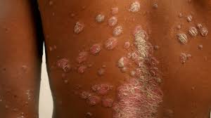 Original How to Treat Skin Rashes in Ibadan in Ibadan Nigeria Buy the original How to Treat Skin Rashes in Ibadan in Ibadan Nigeria
