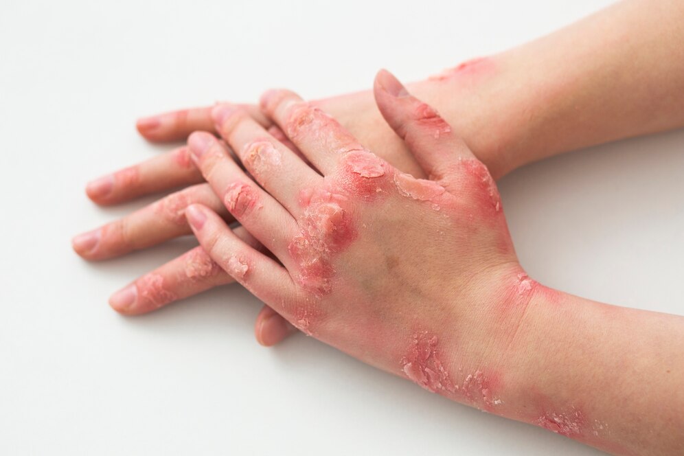 Original Simple Tips for Managing Psoriasis in Ibadan in Ibadan Nigeria Buy the original Simple Tips for Managing Psoriasis in Ibadan in Ibadan Nigeria